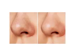 【☆毛穴ケアNo.1☆】毛穴洗浄&美容液（ビタミンC、コラーゲン、ヒアルロン酸）導入✨鼻とホホの毛穴を引き締めつや肌へ✨