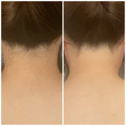 うなじ脱毛(18~29歳限定)