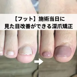 即日見た目改善ができるフット深爪矯正の練習モデルです。