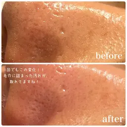 【口コミ価格】ハイドラフェイシャル(毛穴洗浄)×管理栄養士による食事カウンセリング付