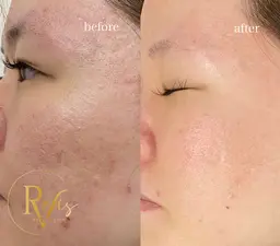 【どんな肌悩みにも対応‼️】プロセルフェイシャル全顔✨️毛穴の開き、ニキビ跡、凸凹肌、シミしわ、たるみ、後戻りなし最新術