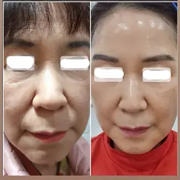 【半額キャンペーン🎉100本美容鍼✨】目の下やおでこ、口周りのお悩みに‼️(頭皮鍼＋100本鍼＋肩ほぐし＋小顔リンパ)