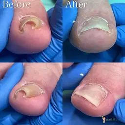 【巻き爪補正】痛みがある方❗️痛みがなくても巻きが強い方⚠️専用の器具で優しく、効果的に施術いたします。