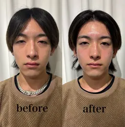 メンズ👨美容鍼【水曜日以外】男性4回モニター様特別価格1回7900円1週間に一度いらっしゃれる方限定🉐EMS🎁付き