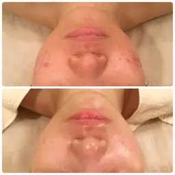 ミニモ限定【ニキビケア/毛穴ケア】肌別ピーリング＋お悩み別ケア＋パック（仕上げUVクリーム）