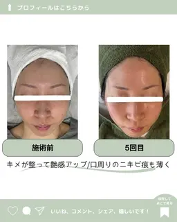 🪸肌質改善ピーリング🪸HAAB REPRO｜ホームケアセット付き