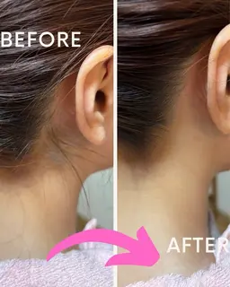 うなじ&襟足シェービング　成人や、脱毛前の形作りに！