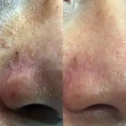 🍓いちご鼻さよなら　毛穴洗浄　ハイドラフェイシャル¥5500