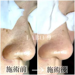 最新毛穴洗浄　毛穴の黒ずみ、詰まり完全除去　通常13000円→ミニモ11000円