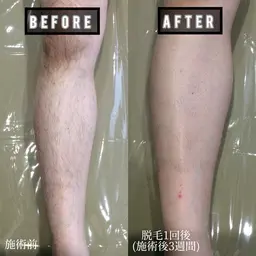 【お試し】全身脱毛 頭の先から足先まで(顔、VIO全パーツ込)