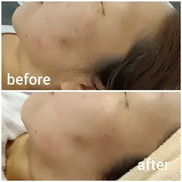 毛穴ケア＋デコルテケア　2回分