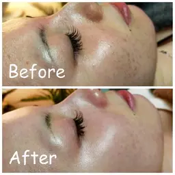 『ハーブピーリング🌿＋毛穴吸引＋ヘッドマッサージ』