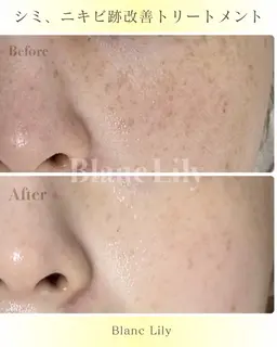 【シミ・ニキビ跡ケアトリートメント】美白ピーリング