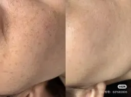 ご新規様限定☘️毛穴洗浄＆DPL光フェシャル