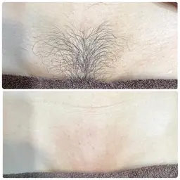 モニター様募集！即効ツルツルずっとツルツル【VIOワックス脱毛＋光脱毛】★ダブル脱毛で来店日からずっとツルスベ♪女性限定