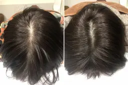 No❶髪/頭皮でお悩み鍼90分🌟ハリ、コシがほしい方【平日日中】頭に鍼で輝く髪に🤭18,700円▶︎10,000