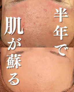 【皮膚科に行っても治らなかった方❕】腸活して内側から美肌に！！フェイシャル＋美腹温神エステ❤️‍🔥