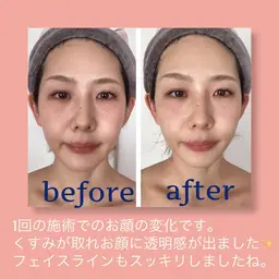 EMSでぐいっと引き上げ👶💫美顔器ありベーシックフェイシャルトリートメント💆‍♀️✨✨