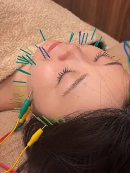 美容鍼50本🪡＋小顔マッサージ＋保湿仕上げ