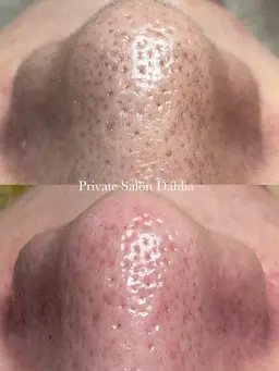 【 いちご🍓鼻改善！ 】ワックス×毛穴洗浄