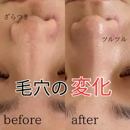 平日限定！毛穴洗浄お試しキャンペーン✨鼻（Tゾーン）、顎のみハイドラフェイシャルエステコース⭐︎