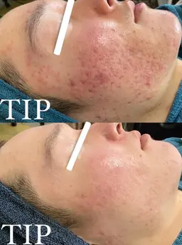 医療提携🫧ハイレベル💎TIPハーブピーリング