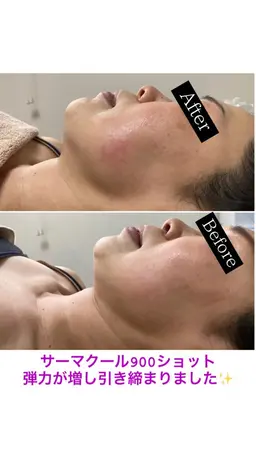 美容クリニックで話題‼️ほうれい線、フェイスラインのもたつき、シワ改善に！直後から引き締めを実感！🫶🏻(全顔)