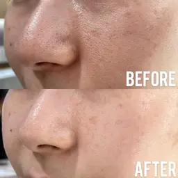 東京最安値‼️毛穴レス！ツヤアップ！韓国ハーブピーリング🌿