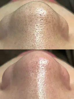 お鼻の黒ずみ撃退！お鼻の毛穴洗浄