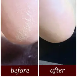 フットケア〔クイック角質ケア〕