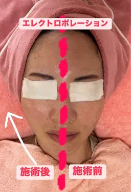 フェイスラインスッキリ！リフトアップ！エレクトロポレーション でコラーゲンを！