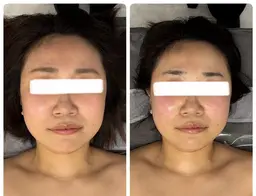 温熱ラジオ派❤️🔥×小顔コルギ💆🏻♀️🫧×小顔定着石膏パック🗿✨