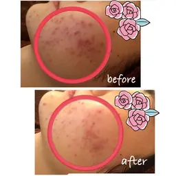 肌再生🌿ハーブピーリング(ハイドラ付き)