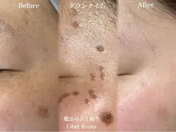 日本上陸！【最新シミ取り】時間制★15分11万/30分15万★2回目無料