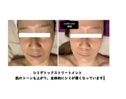 シミデトックストリートメント✨初回限定　6,000円✨