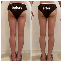 ⭐️ミニモ限定⭐️キャビテーション✖️クラッシュ吸引！下半身痩身コース（太もも表裏・ふくらはぎ）徹底セル分解ケア60分