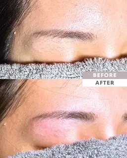 【男女OK】【期間限定▶︎半額！眉毛脱毛（眉周り）✨SNS用撮影モニター様募集（お目元は隠します）