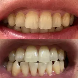 ホワイトニング15分✖️2回