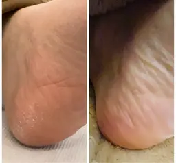 足裏角質＆フットマッサージで冷えむくみ解消