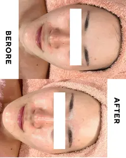 12/20空き◎【年末SALE❤️🔥】肌荒れ・赤み改善✨毛穴洗浄+エレクトロポレーション(高濃度美容液導入)