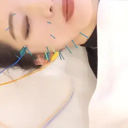 【小顔に特化❣️】もったり顔スッキリ!!小顔美容鍼灸(美容鍼灸+美顔美頭マッサージ)カウンセリング込