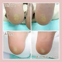 かかと角質ケア　ガサガサして靴下に引っかかる。そんなかかともツルツルに仕上げます。