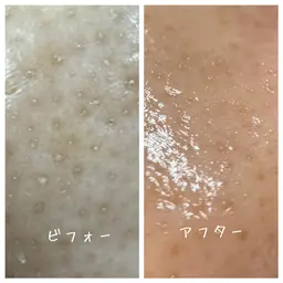 大人気！毛穴の大掃除🧹ピーリングで小鼻つるつるに✨お肌のキメを整えてさらに美肌へ！小鼻ピーリング＋超音波エステ