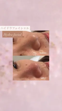 【ニキビ予防に👌🏻】お顔まるごと毛穴洗浄😶‍🌫️×インナーケアカウンセリング込み💫 口コミ価格🙇🏻‍♀️