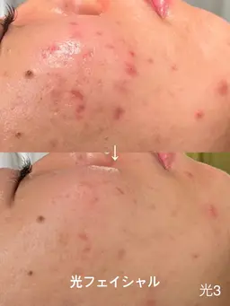 光フェイシャル｜赤み・ニキビ跡・くすみ改善