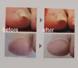 巻き爪ケア