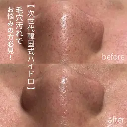 【韓国式毛穴洗浄】毛穴洗浄クーポン👃✨