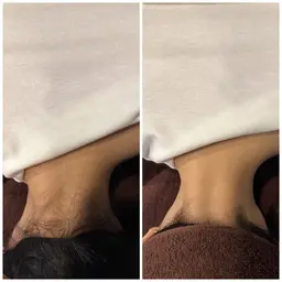 うなじ脱毛🪄髪をまとめる度気になる。そんな方に大人気✨️