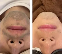 【メンズ脱毛人気No1 】ひげ美肌脱毛¥3980折り返し連絡後確定キャッシュレス決済のみ