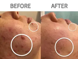 ハーブピーリング×エステ版ダーマ×レチノールパック